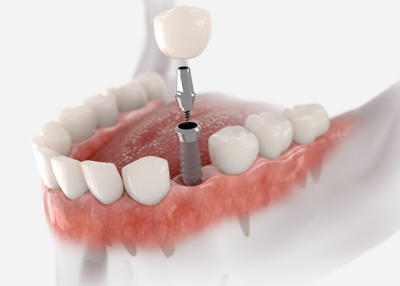 Dental Implant